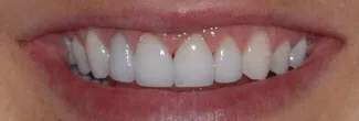 After: four veneers to correct gum line and shade irregularities.