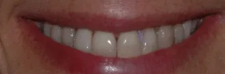 Before: veneers to correct shade, spaces and extensive wear.