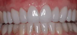 After: gum surgery and veneers to correct gum line and wear issues.