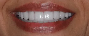 After: invisalign and veneers to correct size discrepancy and severe wear patterns.