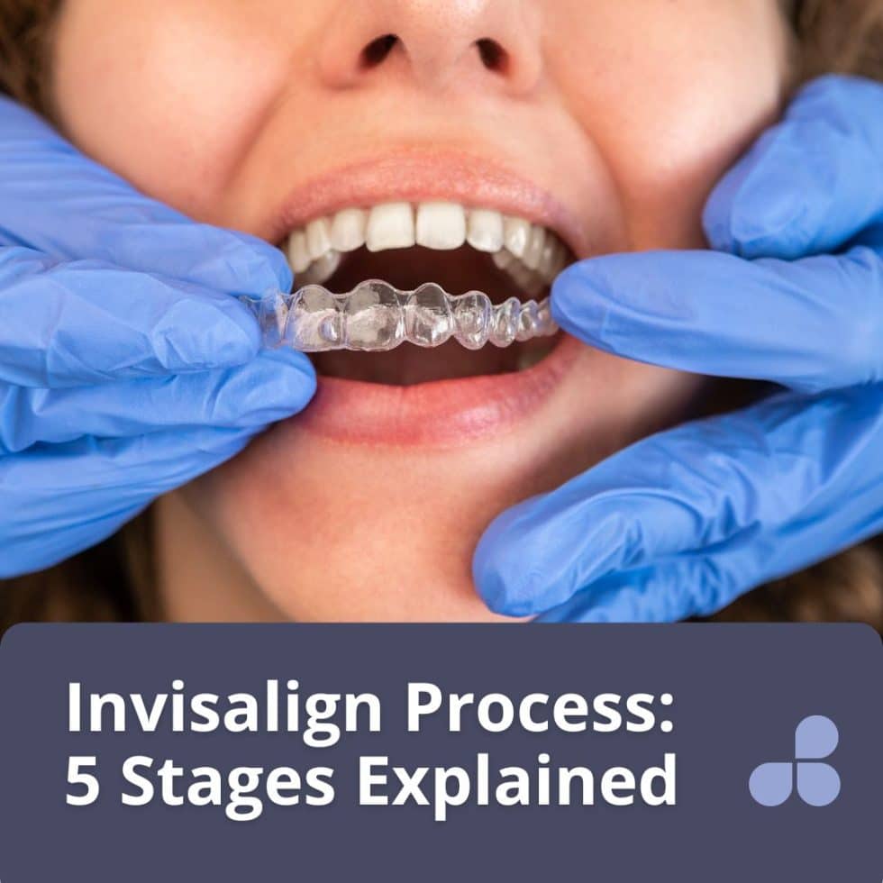 5 Stages Of The Invisalign Treatment Process 5 Stages Of The Invisalign Treatment Process